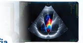 Ecocardiograma Doppler